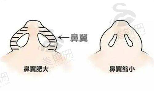 微创双眼皮项目