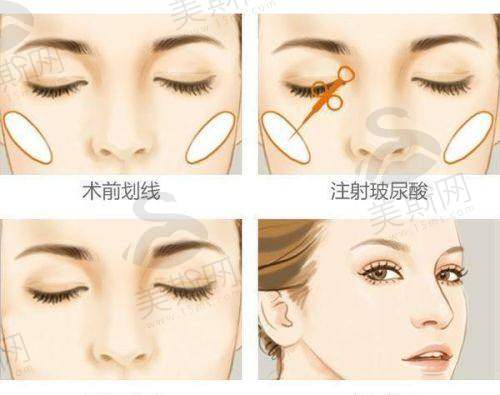 填充苹果肌项目