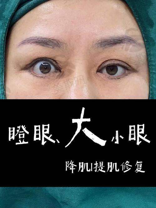实例三:多次鼻修复失败,全肋鼻综合重塑自然挺翘鼻型
