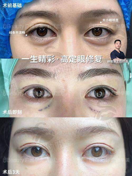 2. 超微创隐痕技术,术后即刻自然