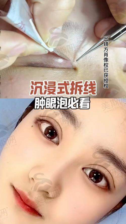 实例一:28岁埋线双眼皮修复,肉条感消失,闭眼无痕
