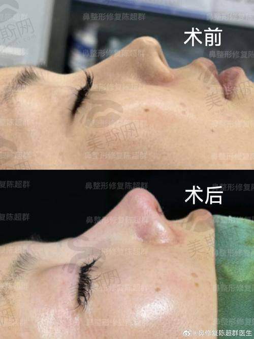 黄惠真医生擅长项目:眼鼻精细化雕刻与修复的全维度覆盖