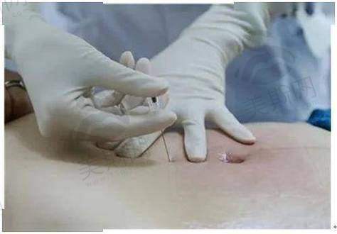 实例3:28岁白领轻薄脸打造,告别“婴儿肥”