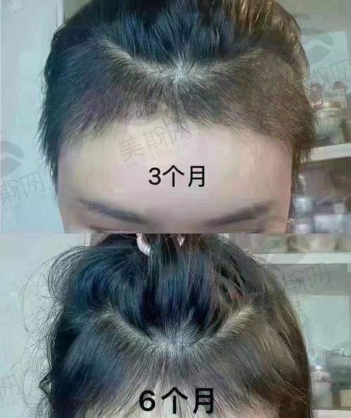 实例二:植发失败修复患者李女士(28岁,教师)