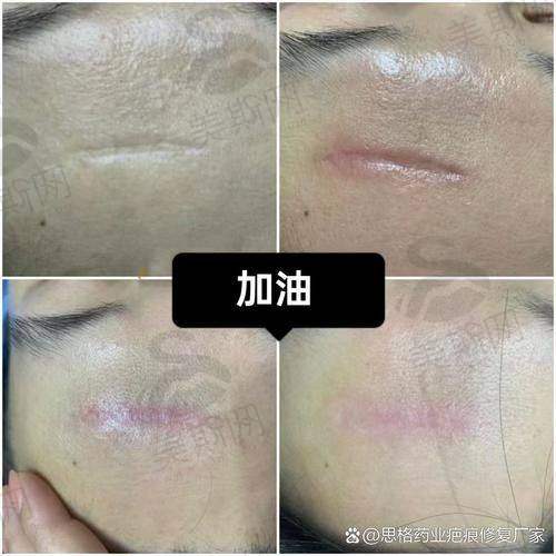 实例三:艺术发际线重塑患者陈女士(32岁,主持人)