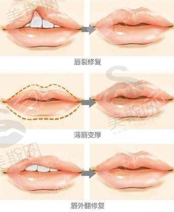 4. 材料联合应用,成效1+1>2