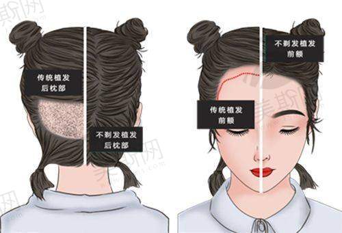 pst面部提升项目