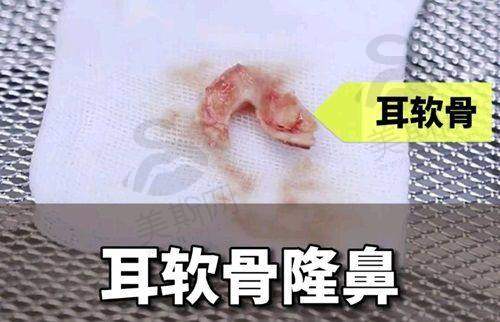 鼻修复项目及价格