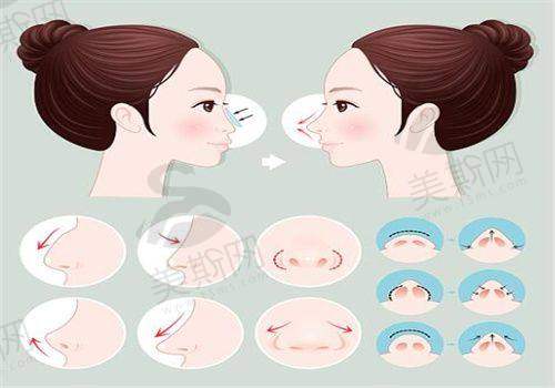 合肥恒美怡人医疗美容门诊部许飞做鼻修复多少钱?10000元起,经验多案例丰富