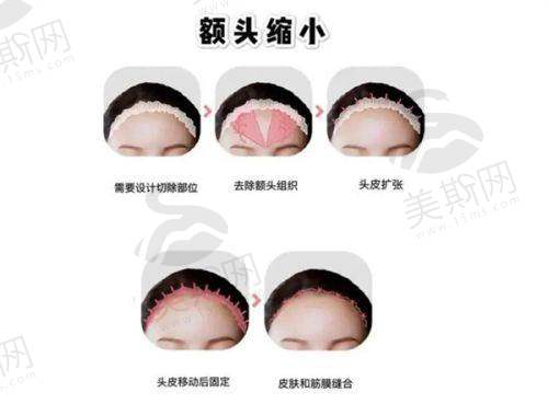 合肥恒美尔爱斯医疗美容门诊部隆胸30000元起,鼻修复优惠,祛眼袋价格实惠效果好