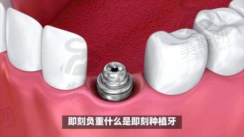 杭州各口腔医院种植牙技术特色