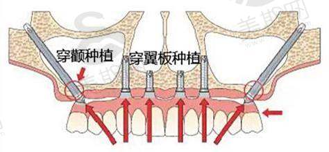 想了解杭州省口腔种植牙价格?杭州满口种植牙价格低至6.6万起,太划算了!