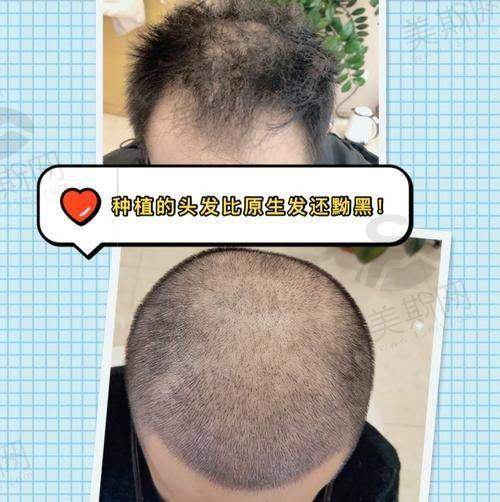 成都恒博头发种植医院技术优势明显吗