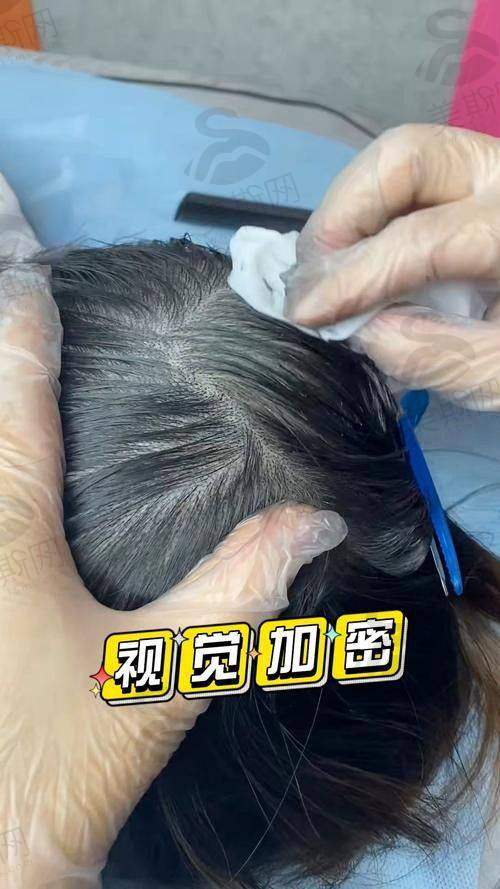 成都恒博头发种植评价好吗