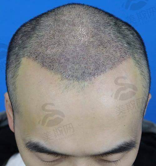 成都恒博头发种植6800包干是真的吗