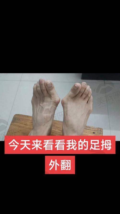 上海虹桥医院拇外翻微创手术技术优势