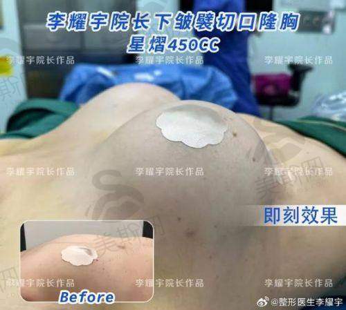 长沙隆胸三等甲医院的技术优势