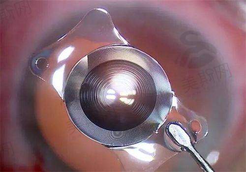 真实患者实例:从“眼前有蚊子”到“海内外变清晰”的逆袭