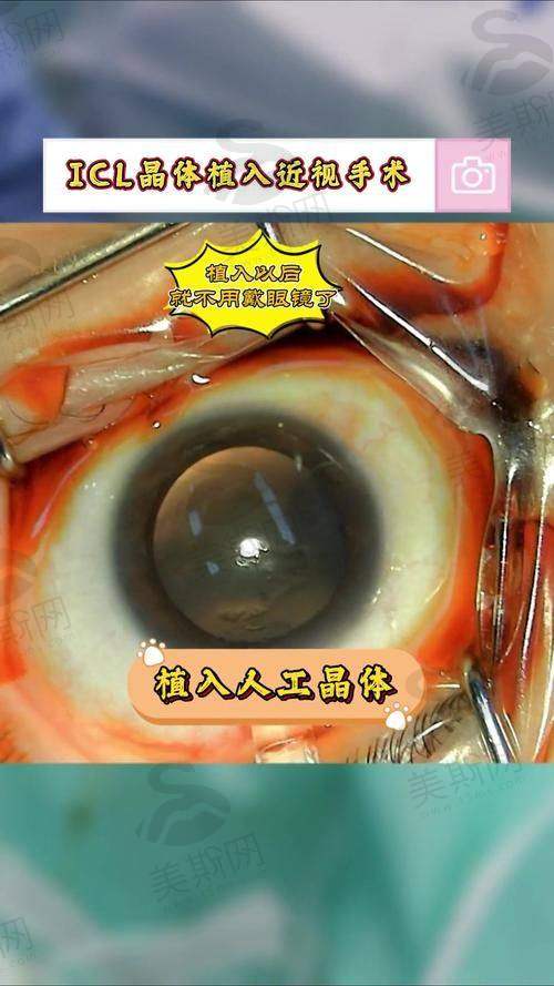 西宁爱尔眼科医院近视手术术前术后避坑指南