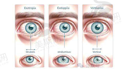 影响北京同仁医院眼科斜视手术价格的“隐形因素”:别忽略这些细节
