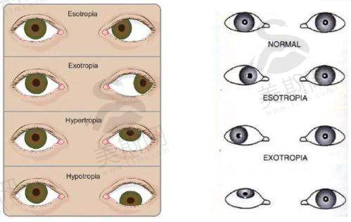 北京同仁医院斜视骨干医生团队:李树宁/万修华亲诊,技术硬价格还公道