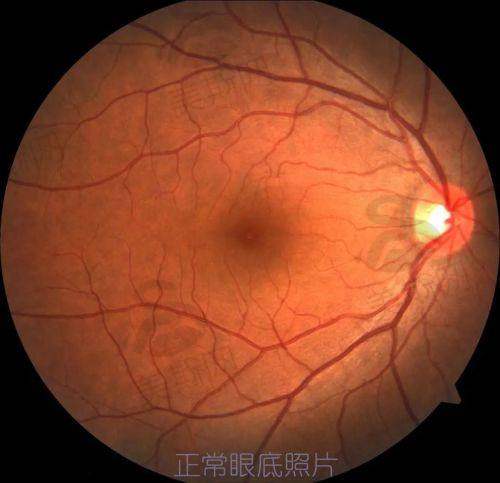 视网膜血管病变治疗真相：这些技术真的能逆转视力吗？