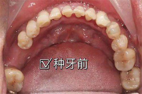 深圳穗华口腔医院补牙怎么样?急诊补牙成效揭秘!