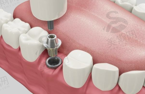 深圳穗华口腔医院靠谱吗？高种牙成功率+低投诉率，实力赢得好口碑！