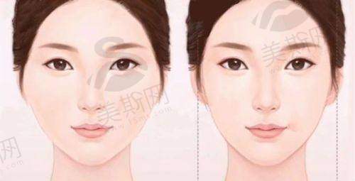 三、韩国Elev皮肤科光电项目技术揭秘