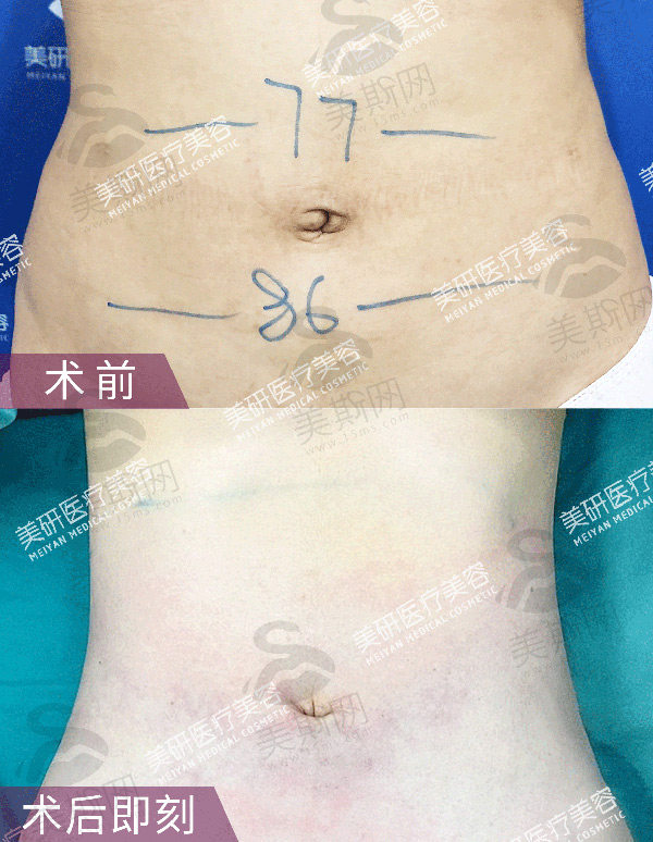 成都军大整形美容医院蒲小兵脂肪技术院长吸脂塑形价格2-6万！多项抽脂技术优势及预约攻略大公开