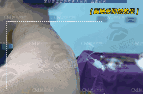 深圳曹孟君治疗富贵包的地址，南山区高新南四道13号微创去除富贵包预约从速